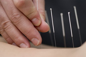Seirin needles from Japan used to reduce pain